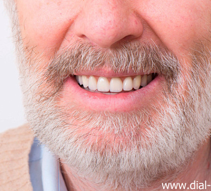 Съемные протезы с балочным креплением на имплантах